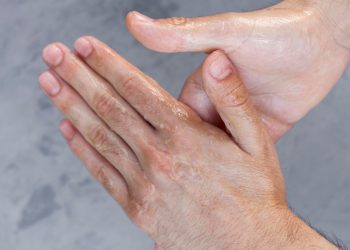 Keringat Tak Terkendali : 5 Fakta Penting tentang Hyperhidrosis