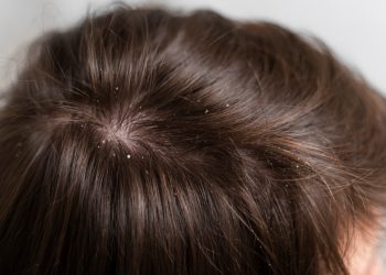 Tips Jitu Hilangkan Ketombe: Bebas Gatal dan Bikin Percaya Diri Lagi