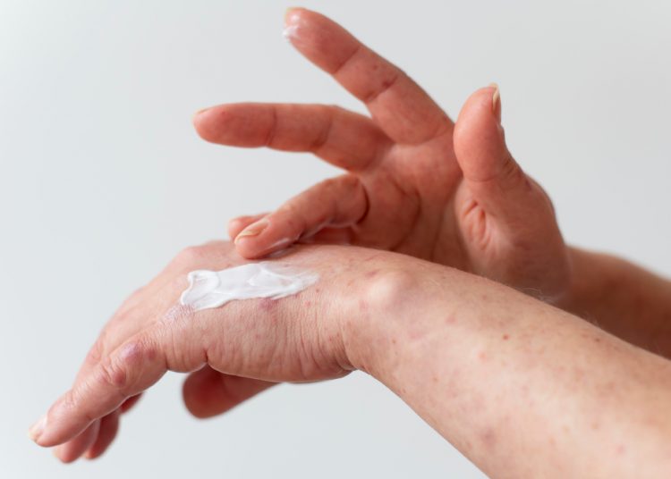 Coba 4 Cara Ini Untuk Atasi Kulit yang Bersisik