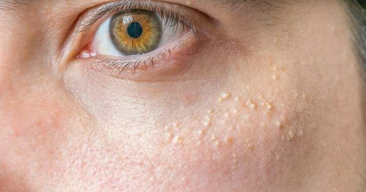 Ini Dia 6 Cara Menghilangkan Milia pada Wajah