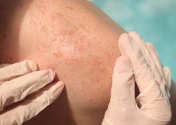 Cara Mencegah Biang Keringat Secara Alami Tanpa Obat Kimia