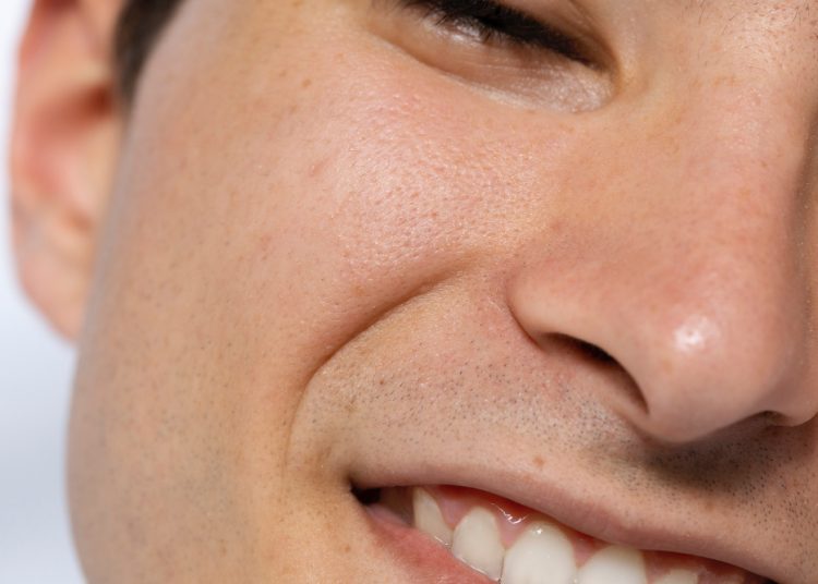 Bisa Timbulkan Permasalah Kulit di Wajah, Yuk Cari Tahu Ciri-ciri Pori Tersumbat