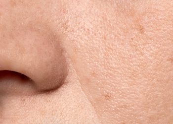 Kenali 8 Penyebab dan Cara Mengencangkan Kulit Wajah yang Kendur