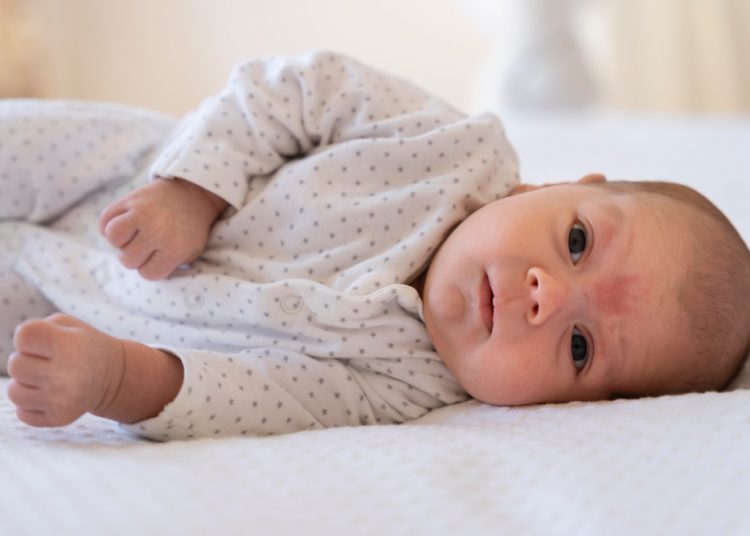 Cara Ampuh Mengatasi Biang Keringat Pada Bayi dan Anak