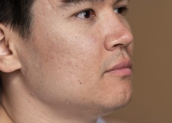 Terbukti Bantu Menghilangkan Flek Hitam dan Jerawat, dr Zaidul Akbar Bagikan Resepnya