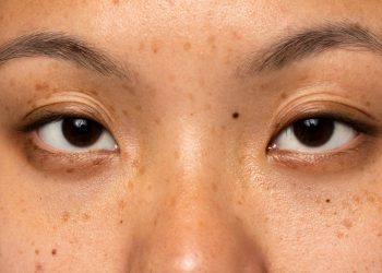 Ingin Hilangkan Tahi Lalat Secara Permanen? Coba 5 Bahan Alami Ini